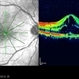 Tuberculosis retinochoroiditis